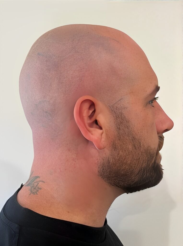 Resultado despues de la eliminacion de tatuaje de cabeza con laser PicoWay - Ink Rewind Tattoo Removal