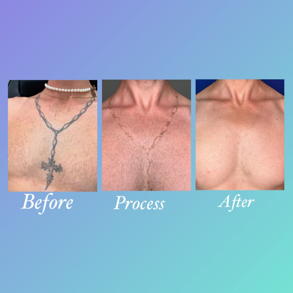 Progreso de eliminacion de tatuaje de collar en el pecho con laser PicoWay - Ink Rewind Tattoo Removal
