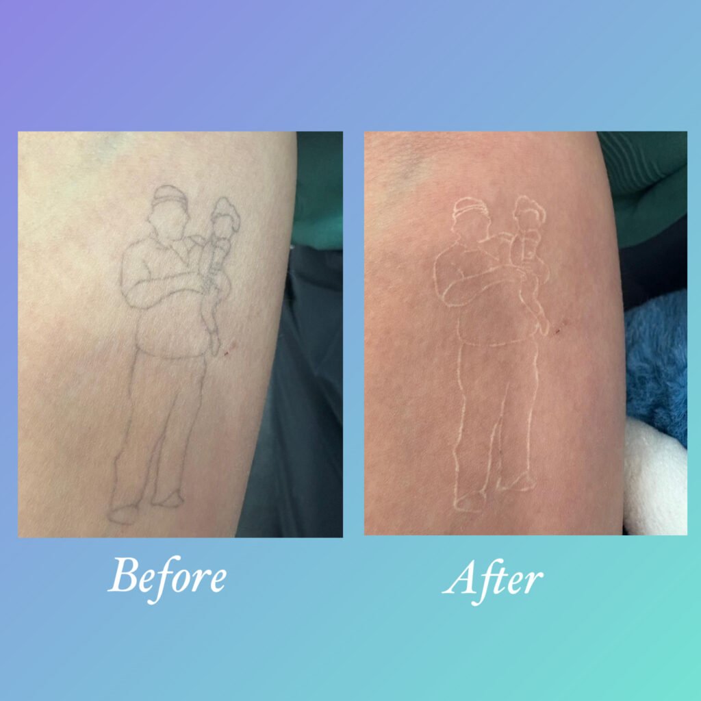 Antes y despues de eliminar tatuaje con laser PicoWay - Ink Rewind Tattoo Removal