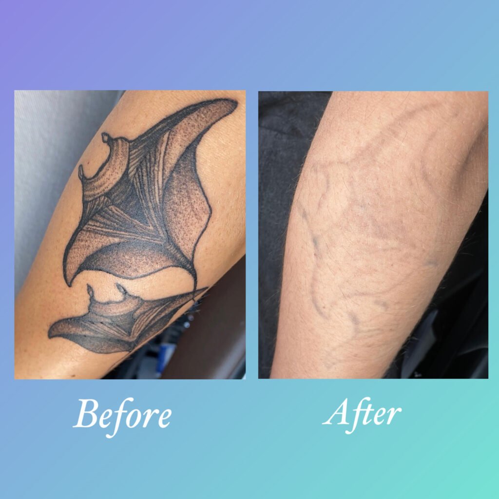 Antes y despues de eliminar tatuaje con laser PicoWay en Ink Rewind, Coral Gables