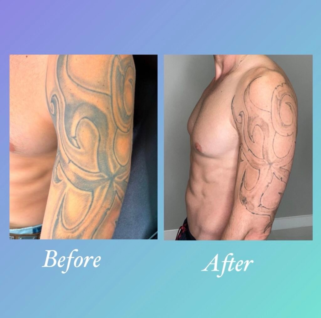 Antes y despues de eliminar tatuaje en el brazo con laser PicoWay - Ink Rewind Tattoo Removal