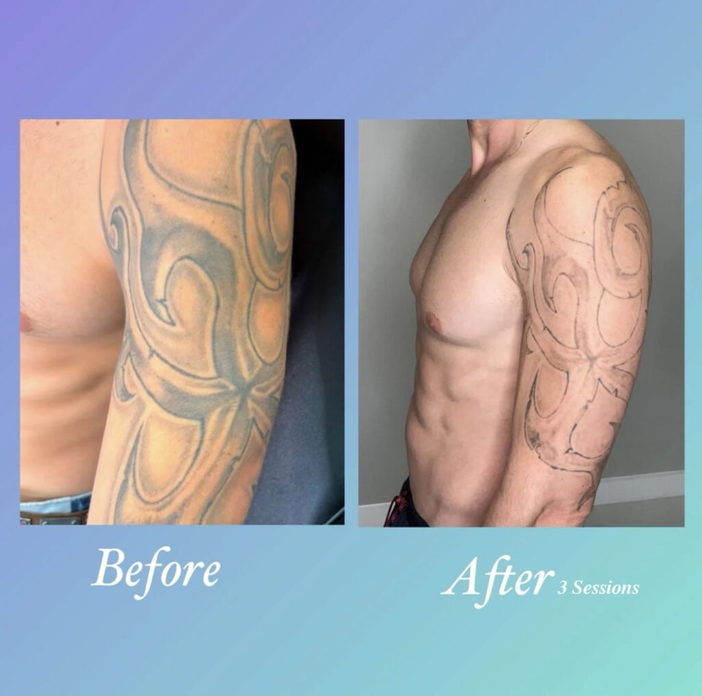 Antes y despues de eliminar tatuaje de brazo con laser PicoWay - Ink Rewind Tattoo Removal